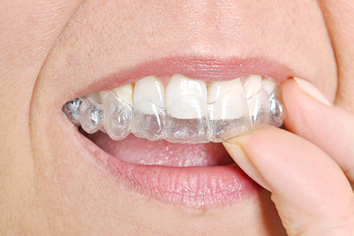 歯ぎしりの原因と影響